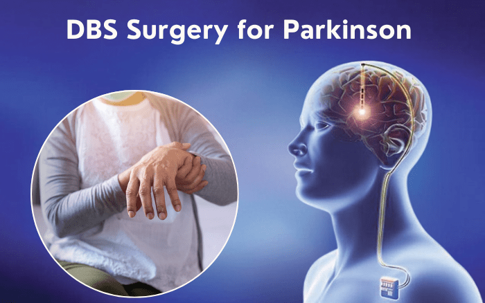 DBS Surgery for Parkinson’s: How It Works and Who Can Benefit