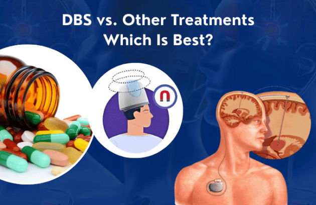 DBS vs. Other Treatments: What’s Best for You?
