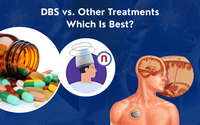 DBS vs. Other Treatments: What’s Best for You?