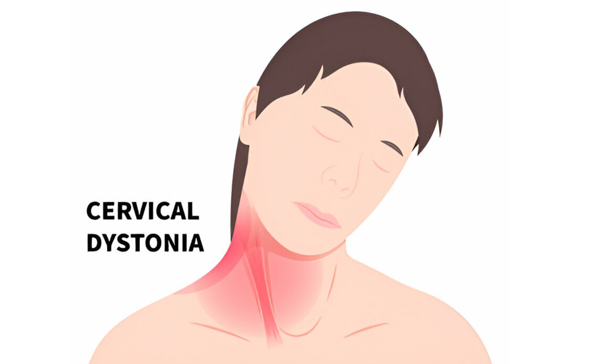 Dystonia Treatment in Pune by Dr. Ninad Patil