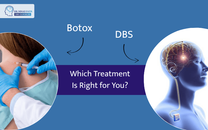 DBS vs Botox for Dystonia: Which Treatment Is Right for You?