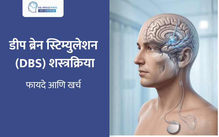 डीप ब्रेन स्टिम्युलेशन (DBS) शस्त्रक्रिया: फायदे आणि खर्च